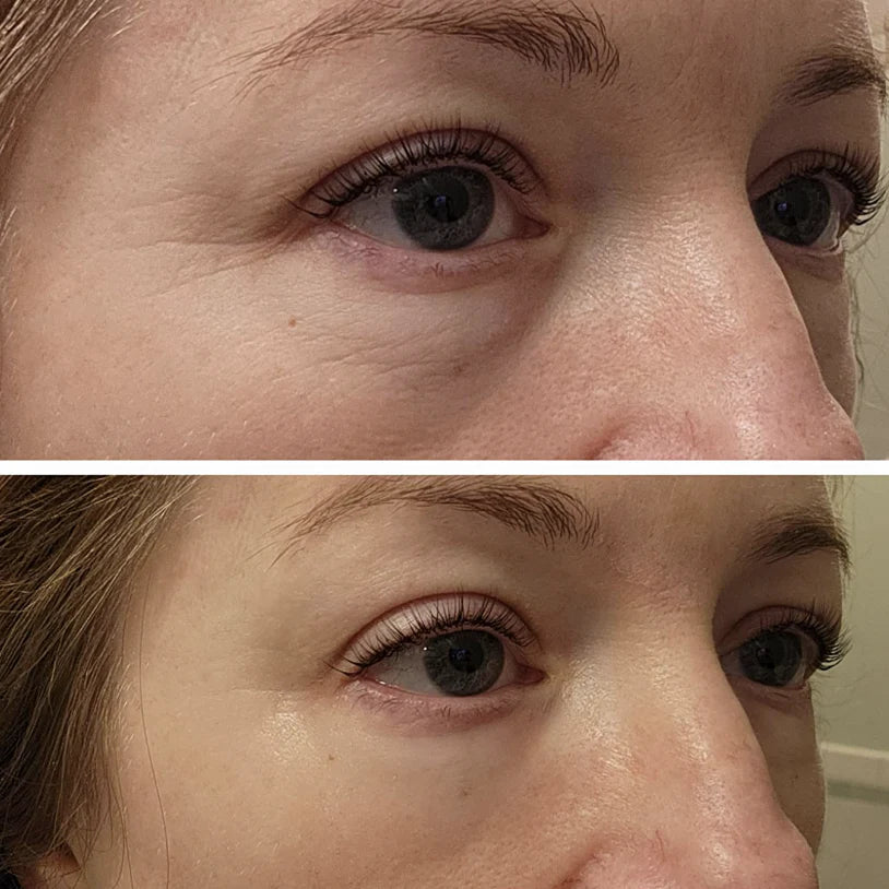 Instant Firmex Eye Tightener